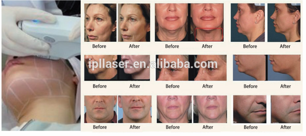 Medical Non - Invasion Ultrasound Face Lift Machine Eye Bags Removal