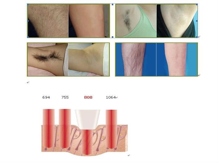 2000W Laser Hair Removal Equipment With 8.4 Inch Color Touch Display
